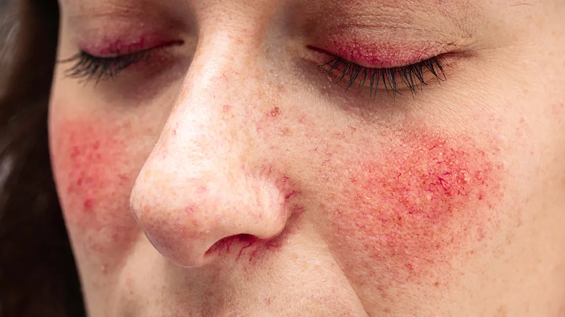 Rosacea