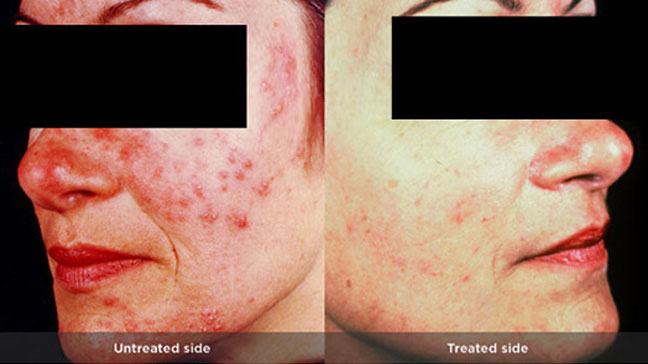 Rosacea