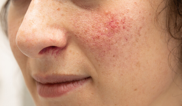 Rosacea