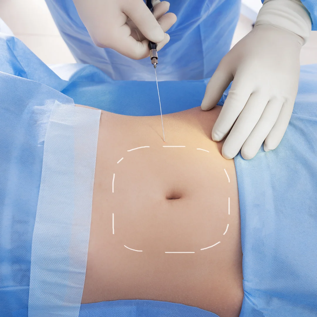 Laser-assisted lipolysis (for fat reduction)