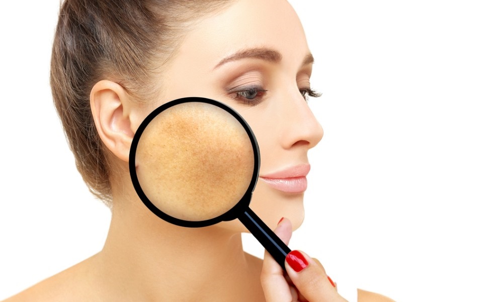 Hyperpigmentation