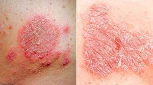 Eczema or Psoriasis