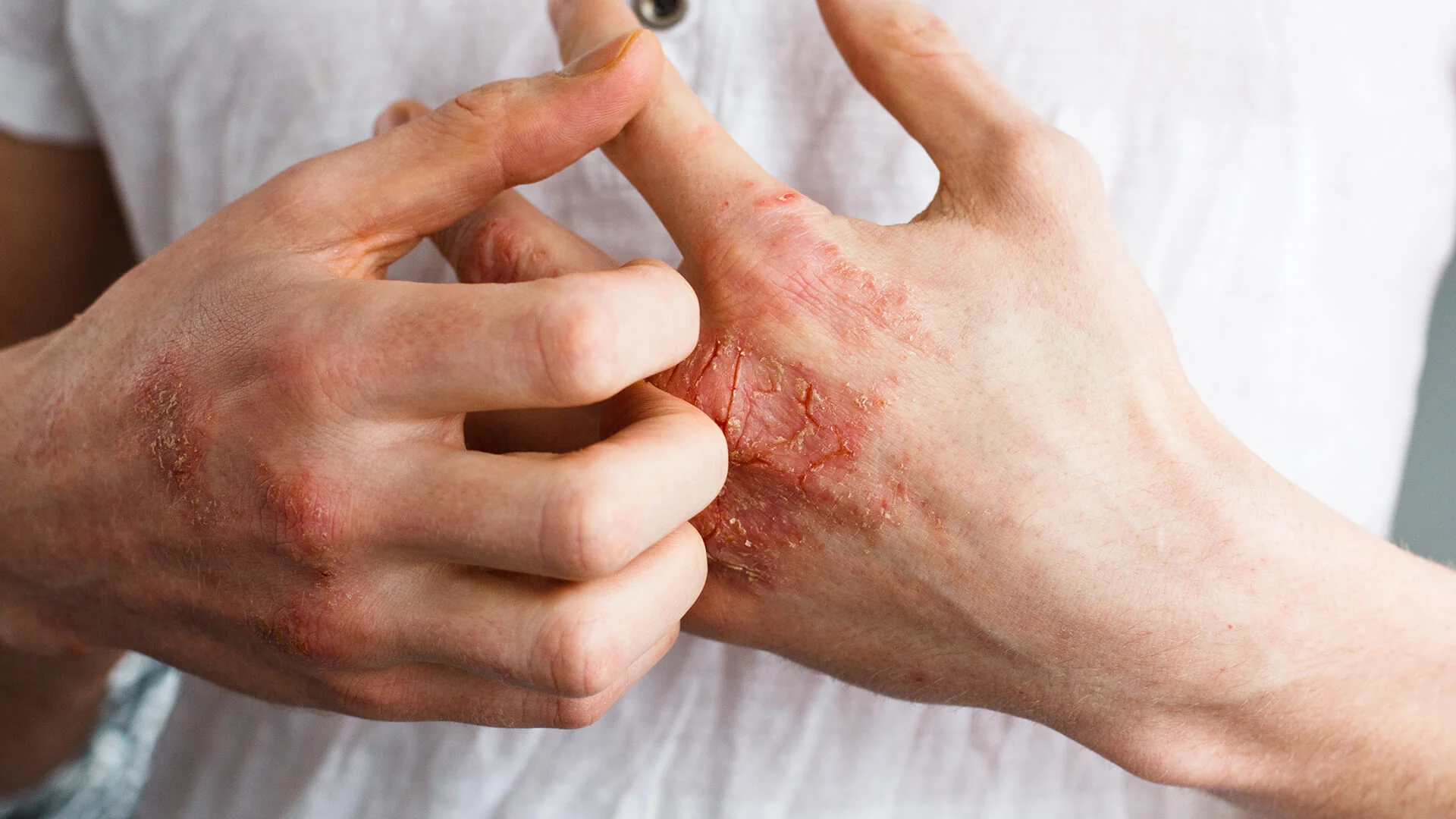 Eczema or Psoriasis