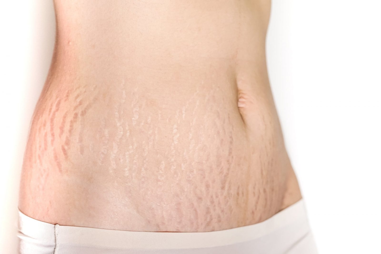 Stretch Marks and Common Treatment