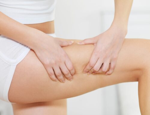 Understanding Stretch Marks and Common Treatment Options