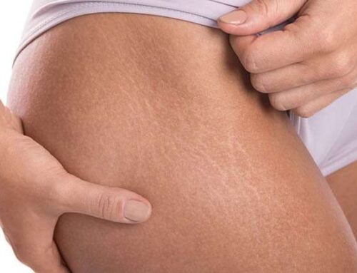Natural Approaches to Minimize Stretch Marks
