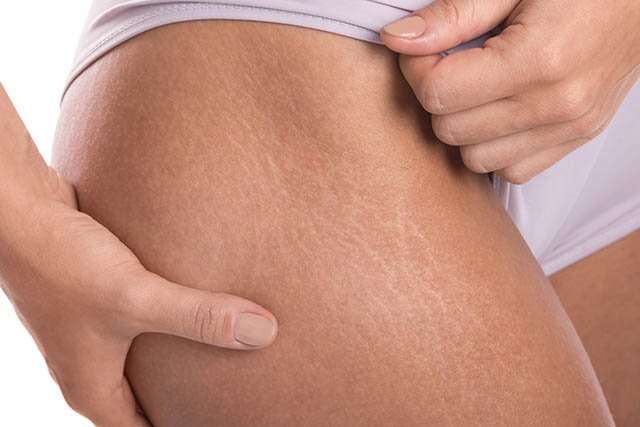 Natural Approaches to Stretch Marks