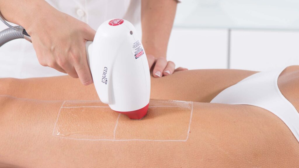 Advantages of Laser Hair Removal