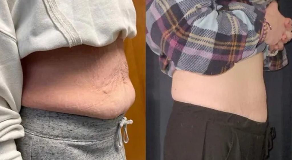 EMS Before after