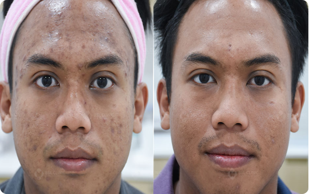 Laser Resurfacing (Before&After)