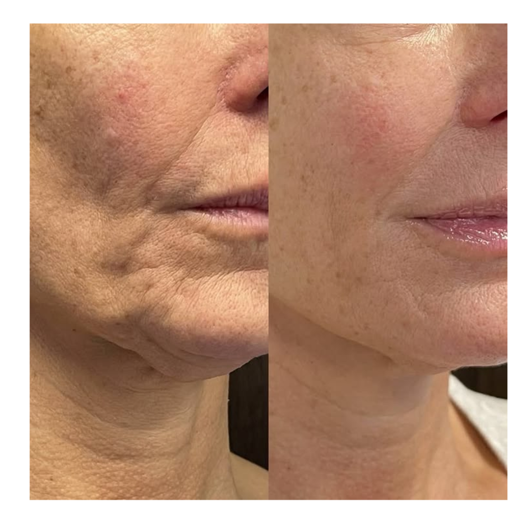 Microneedling (Before&After)