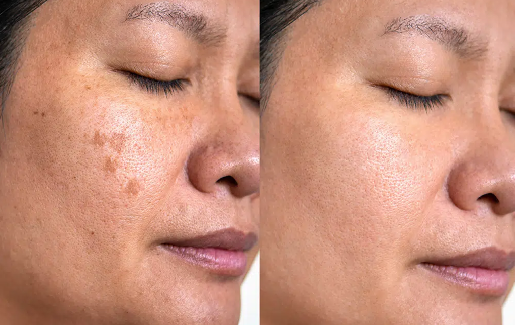 Q Siwtch Before After